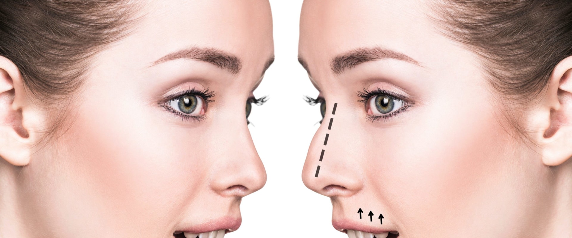 All You Need to Know About Rhinoplasty