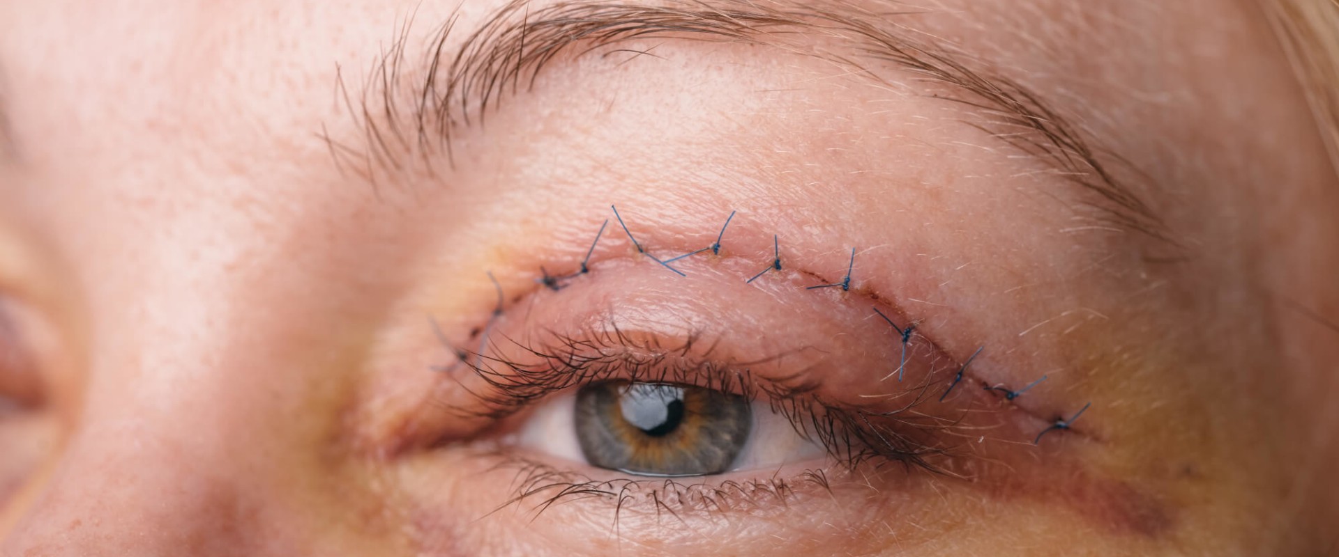 Eyelid Surgery: What You Need to Know