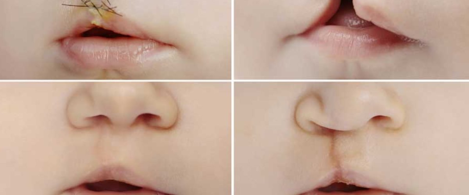 Understanding Cleft Lip and Palate Repair Surgery