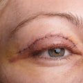 Eyelid Surgery: What You Need to Know