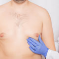 Male Breast Reduction: What You Need to Know