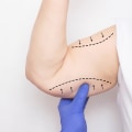 The Ultimate Guide to Arm Lift Surgery