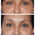 All You Need to Know About Brow Lift Surgery