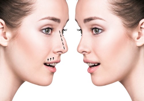 All You Need to Know About Rhinoplasty