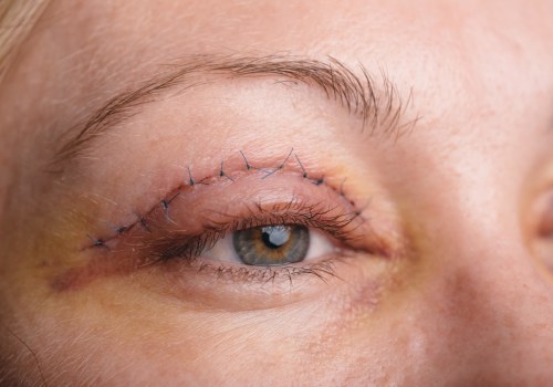 Eyelid Surgery: What You Need to Know