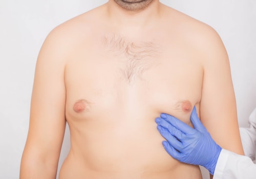 Male Breast Reduction: What You Need to Know