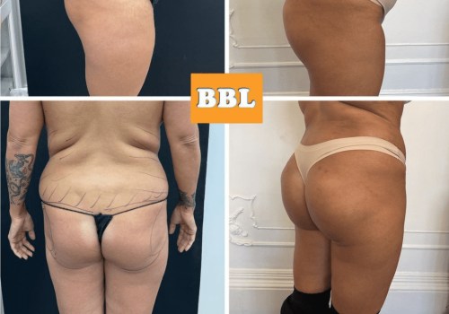 All You Need to Know About Brazilian Butt Lift