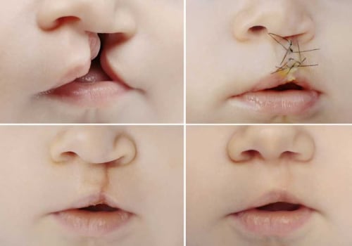 Understanding Cleft Lip and Palate Repair Surgery