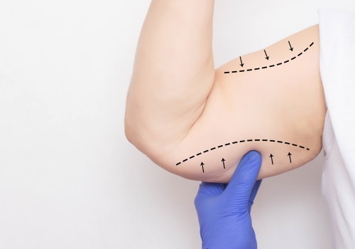 The Ultimate Guide to Arm Lift Surgery