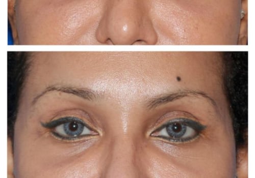 All You Need to Know About Brow Lift Surgery